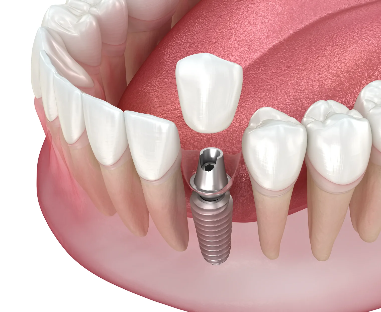 A single implant and its crown between two natural teeth (model)