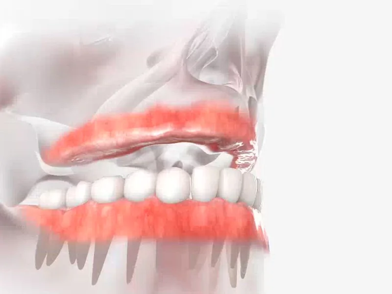 An illustration of a full arch of teeth fixed on implants in the jaw