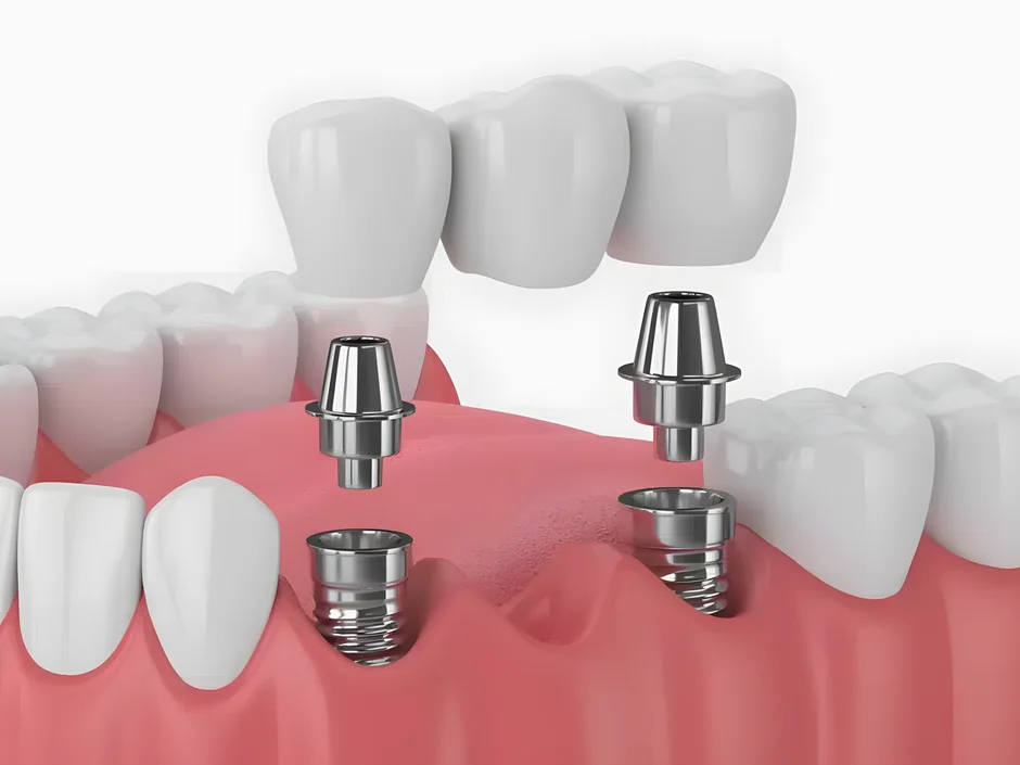 An illustration of a three-tooth bridge lowered onto two implants in the jaw