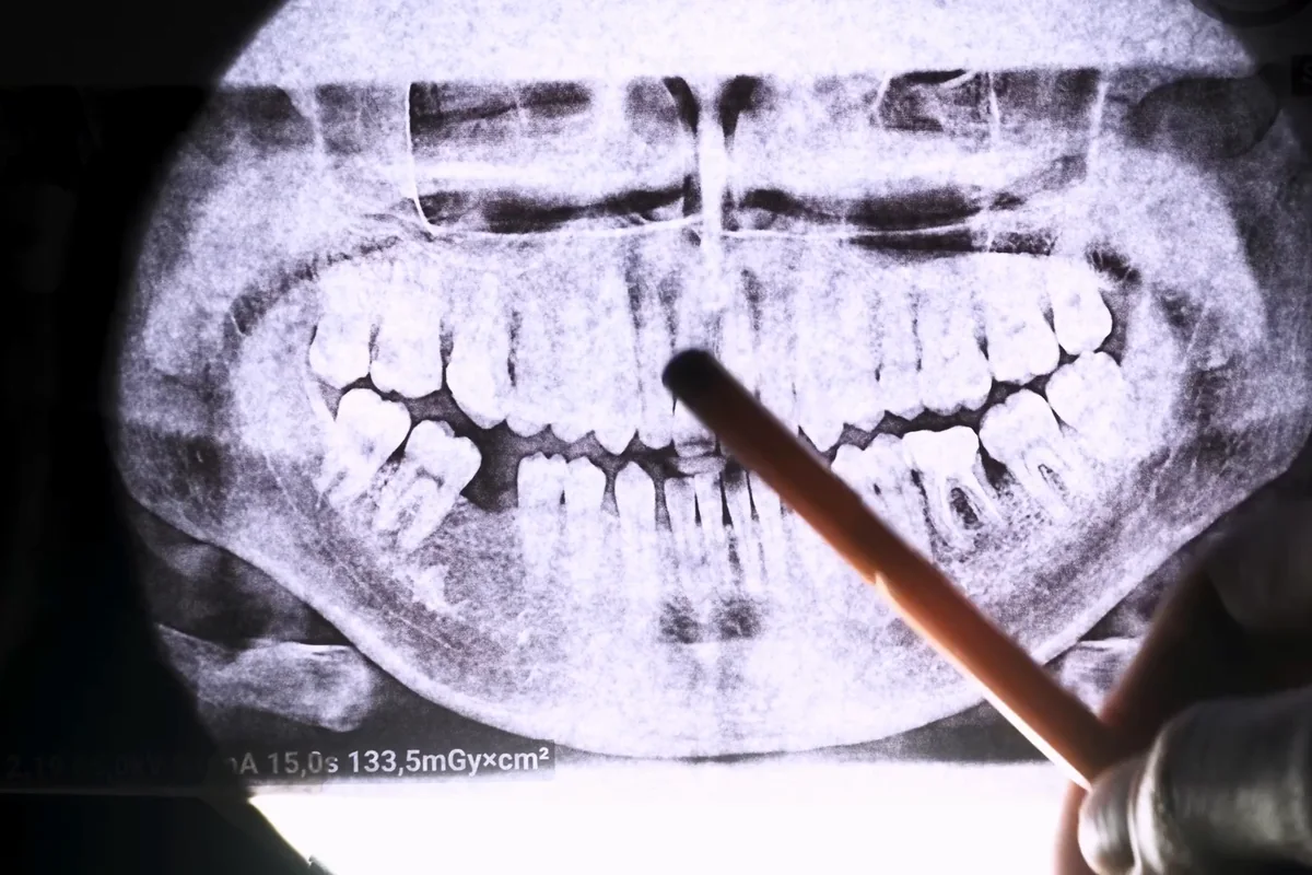 A panoramic X-ray of a patient's jaw with missing teeth, under a pointer