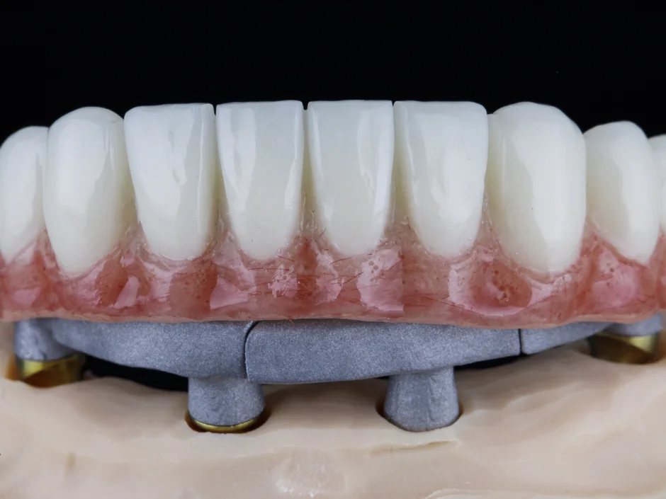 A full arch of zirconia teeth on its implant bar, on a dental model