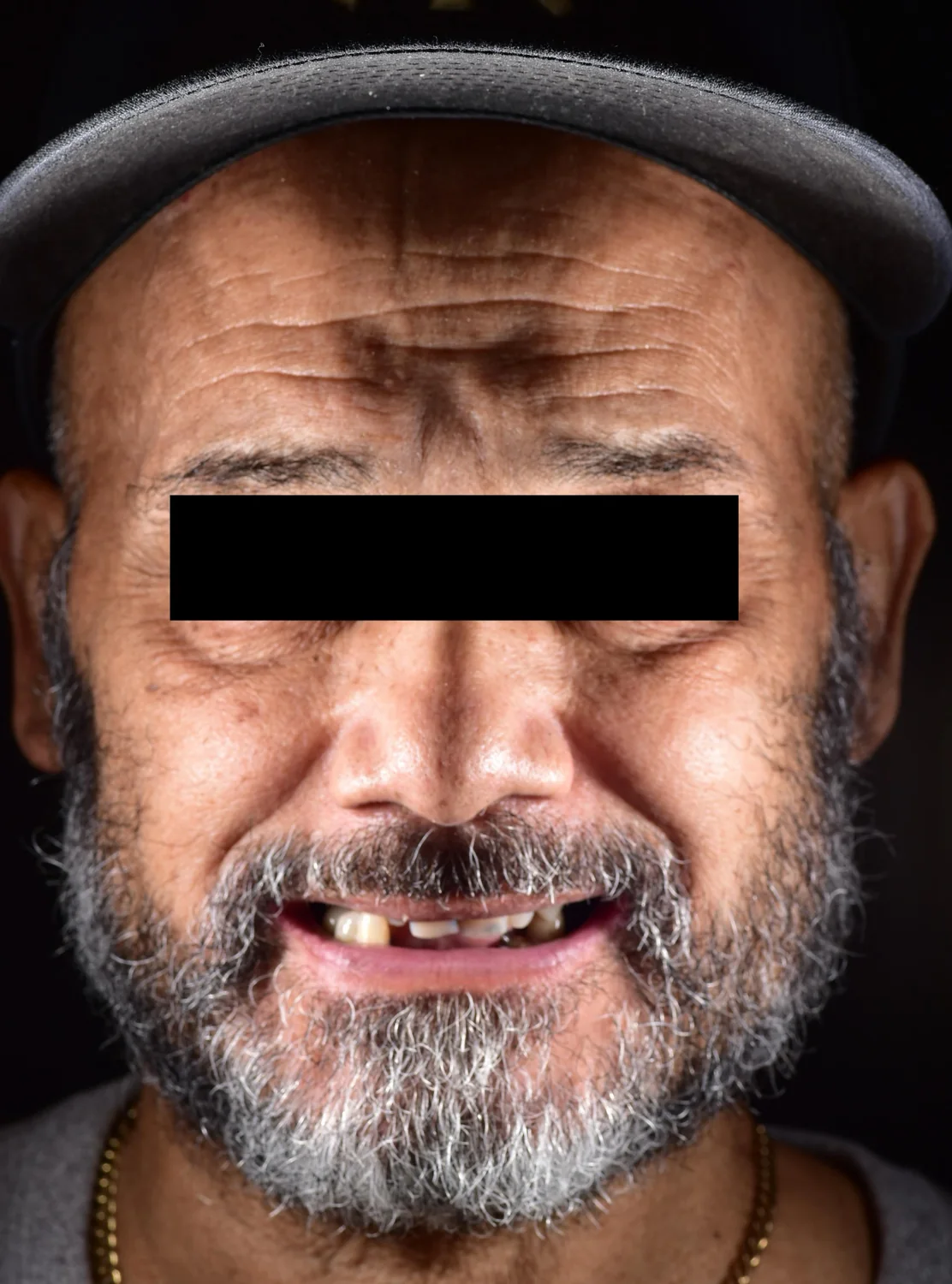 Patient 4 before treatment