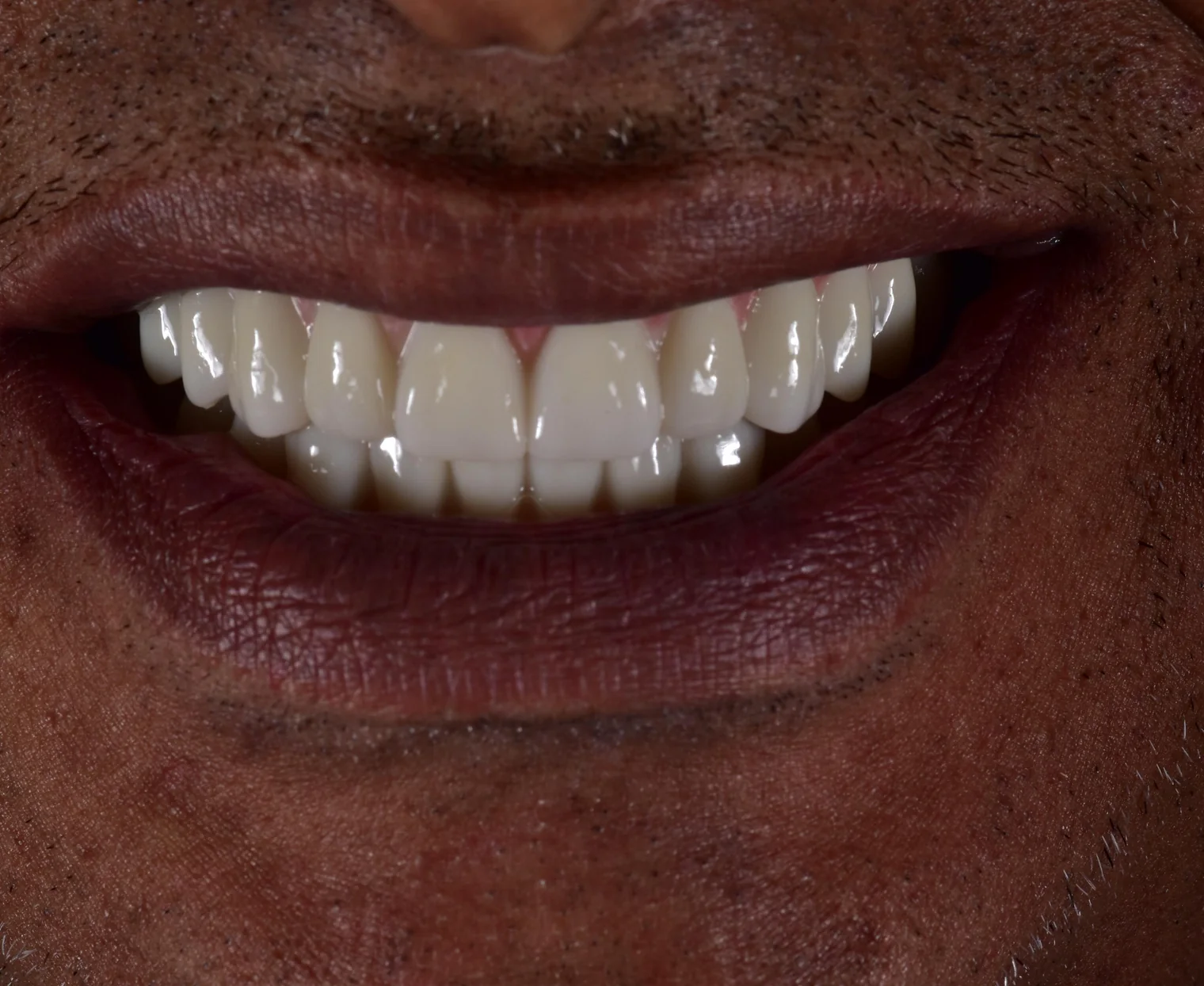 A full-arch implant restoration on a model of the jaw