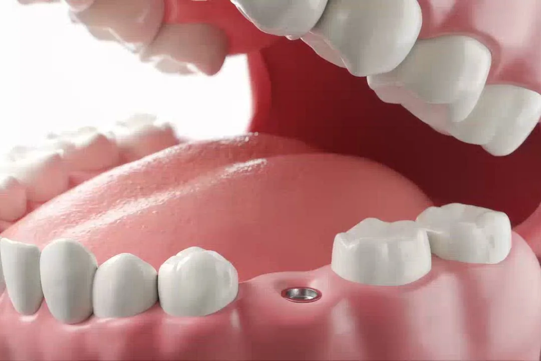 A model of the jaw with an implant post healing in the gap of a missing tooth