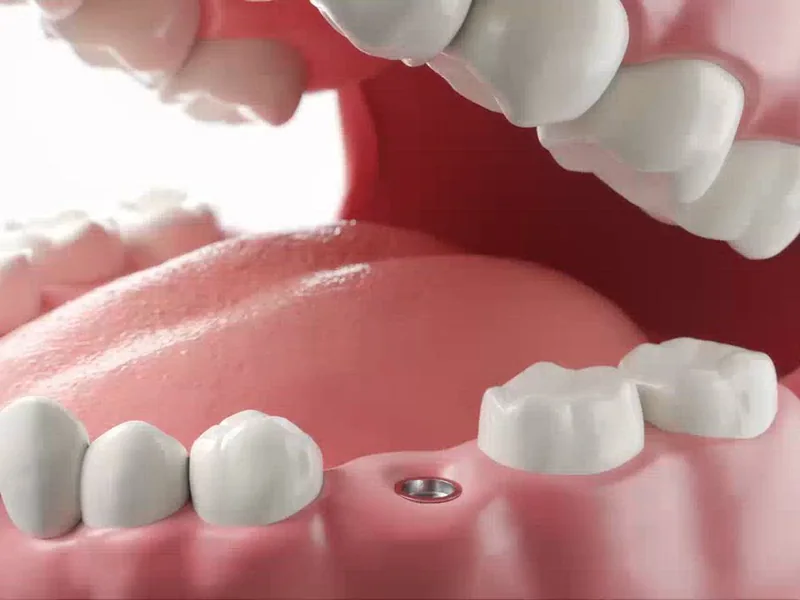 A model of the jaw with one implant post placed in the gap of a missing tooth