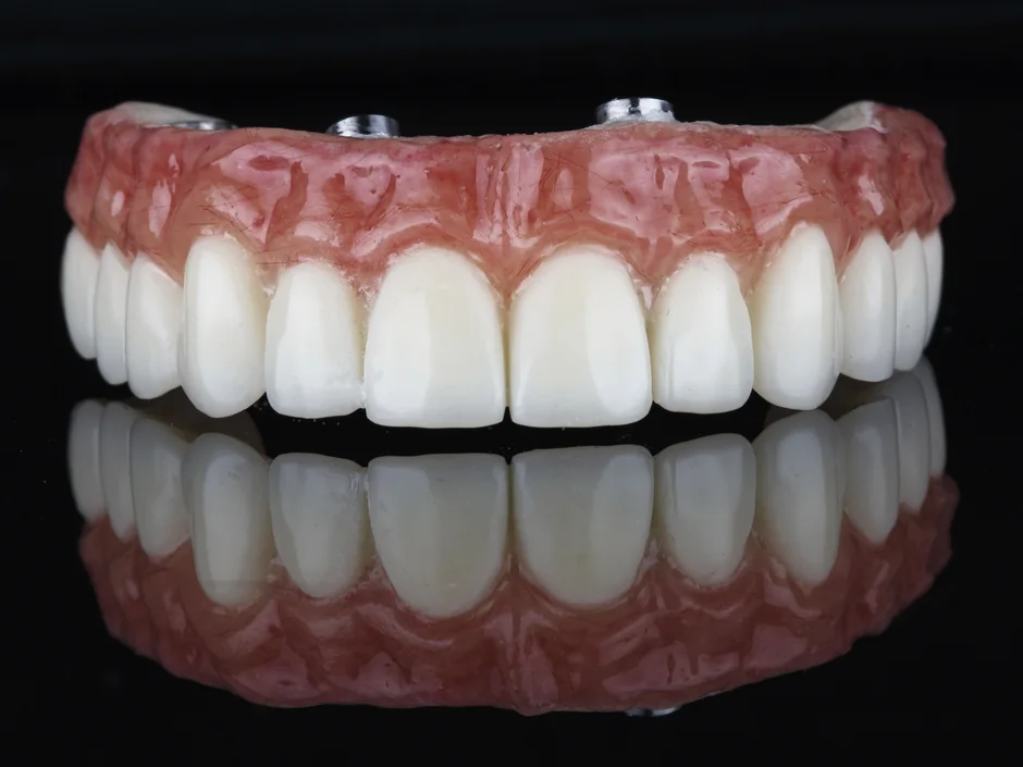 A full-arch set of acrylic teeth with pink gum, made to fix on implants