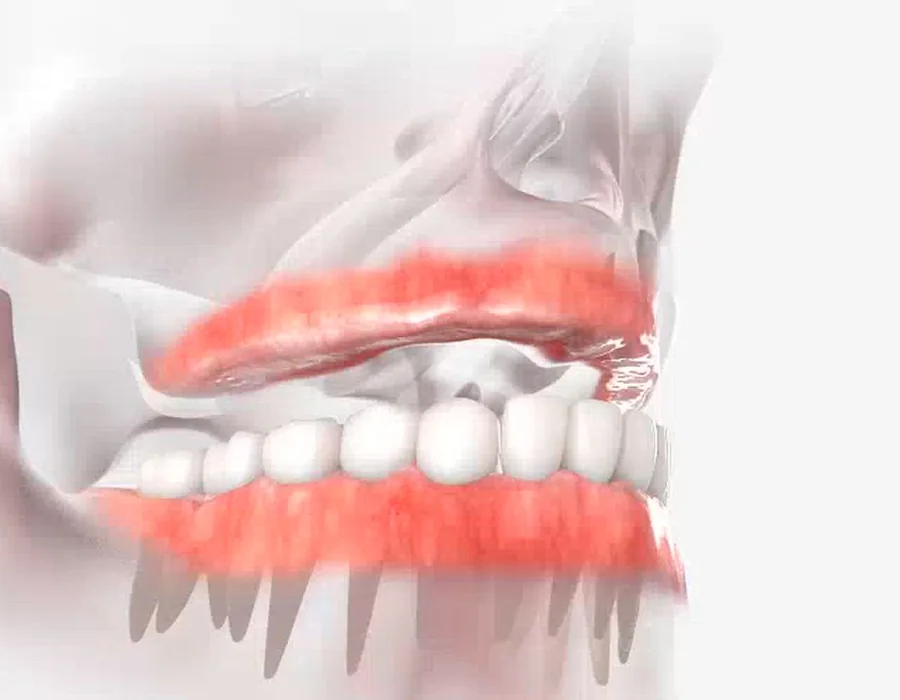 A full arch of teeth on implants (3D illustration)