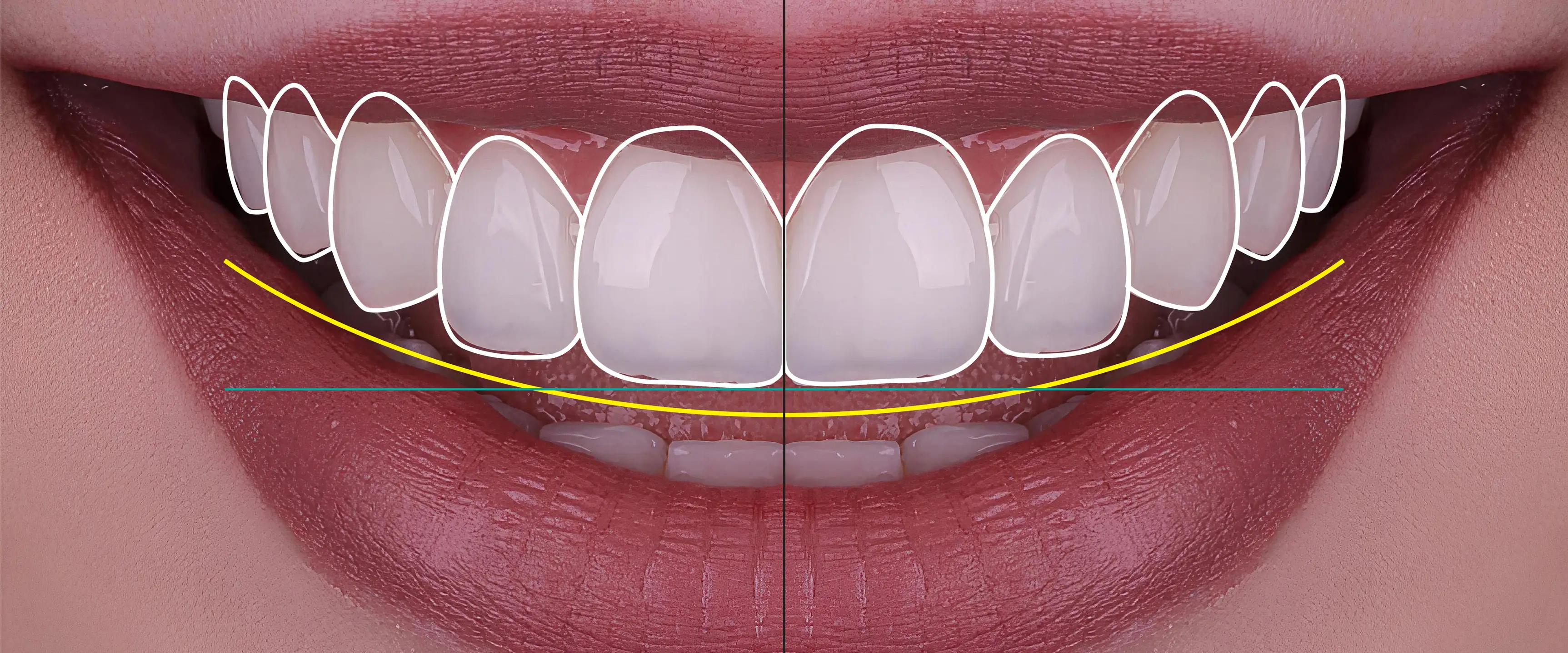 A smile design traced over a row of front teeth
