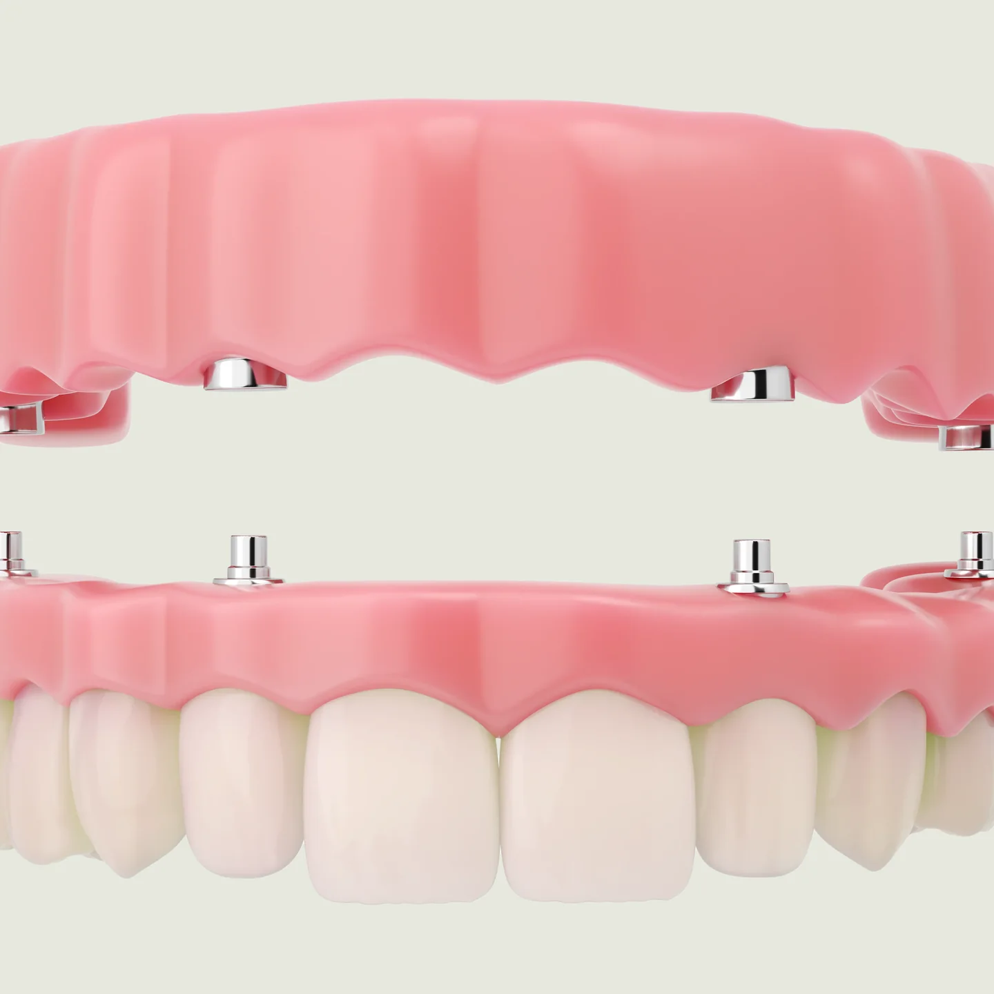 An upper and a lower full-arch restoration, each fixed on implants (model)