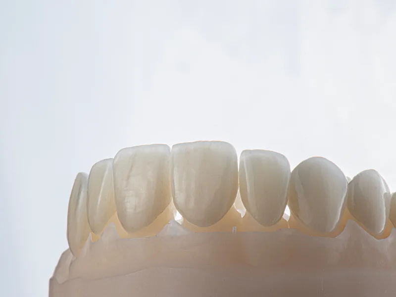 A full arch of ceramic teeth made for a full-mouth restoration, on a model
