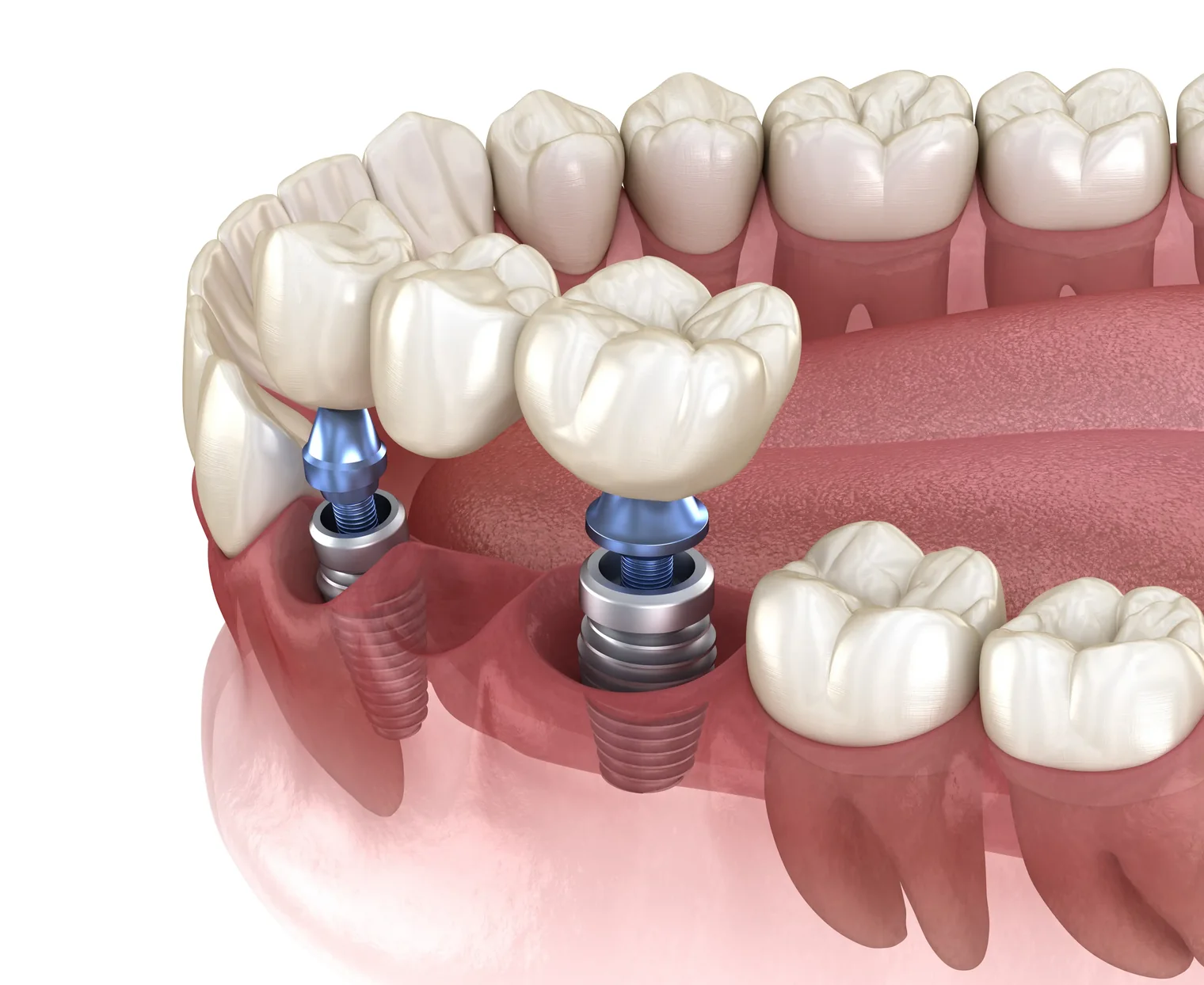 A bridge of three teeth held by two implants in the jaw (model)