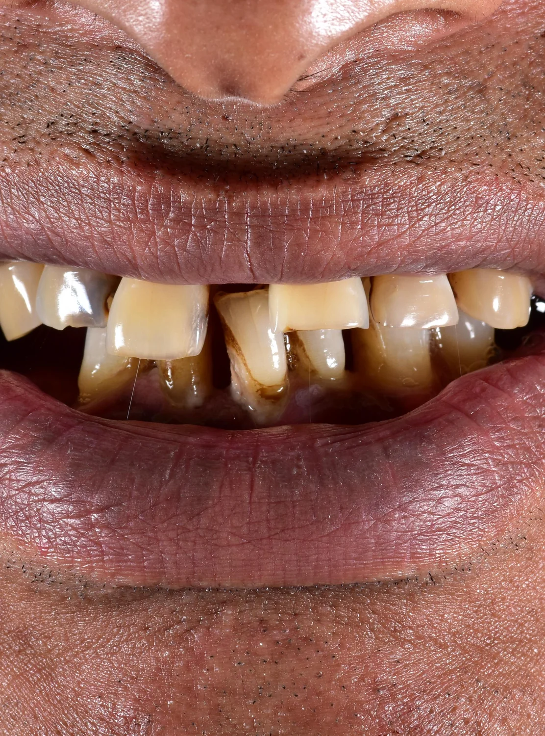 Patient 6 before treatment