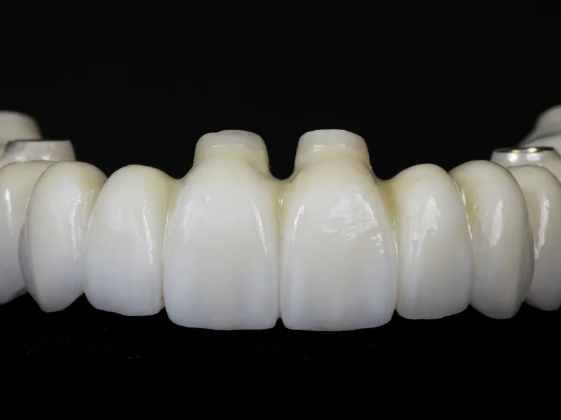 A full-arch bridge milled from solid white zirconia