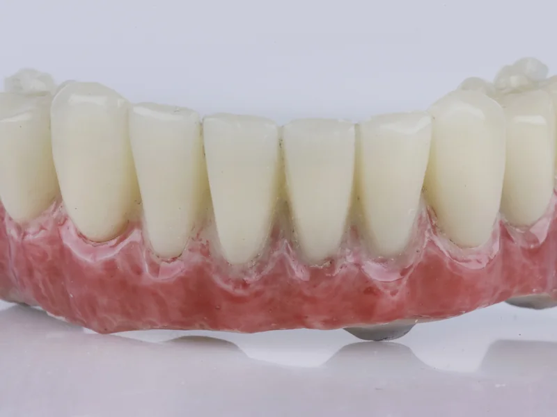 A full-arch acrylic set of teeth, the kind fixed on implants on surgery day