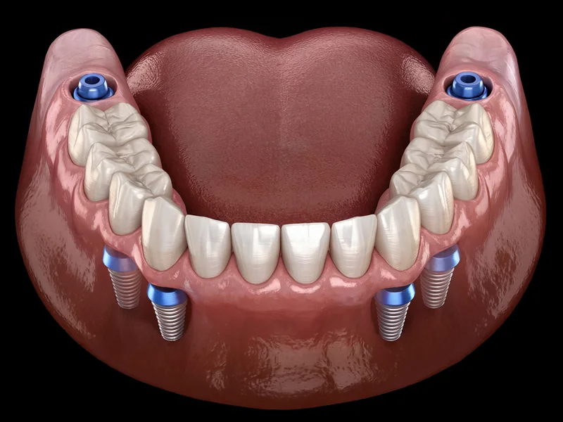 An illustration of a lower full arch fixed on four implants