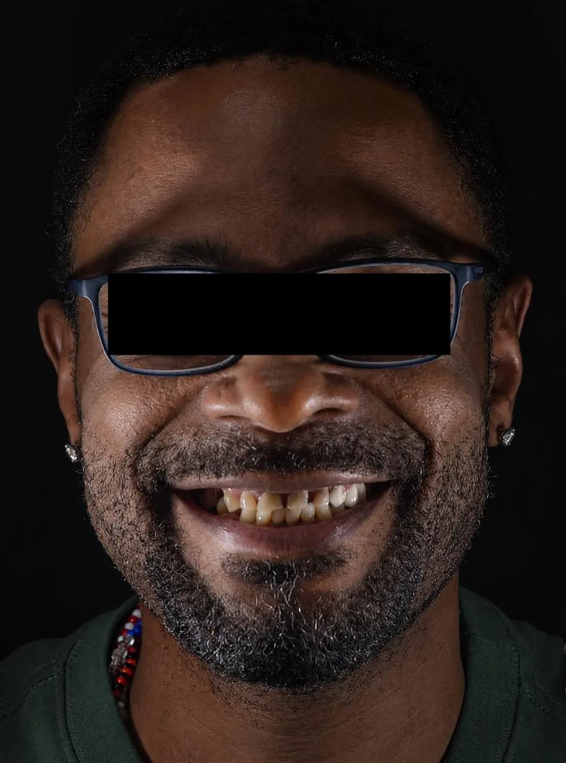 Patient two before dental implant treatment