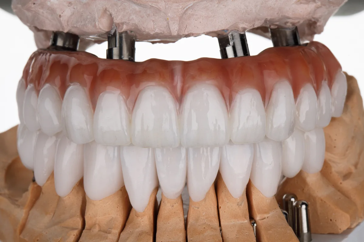 Fixed full-arch teeth for the upper and lower jaw on a dental model