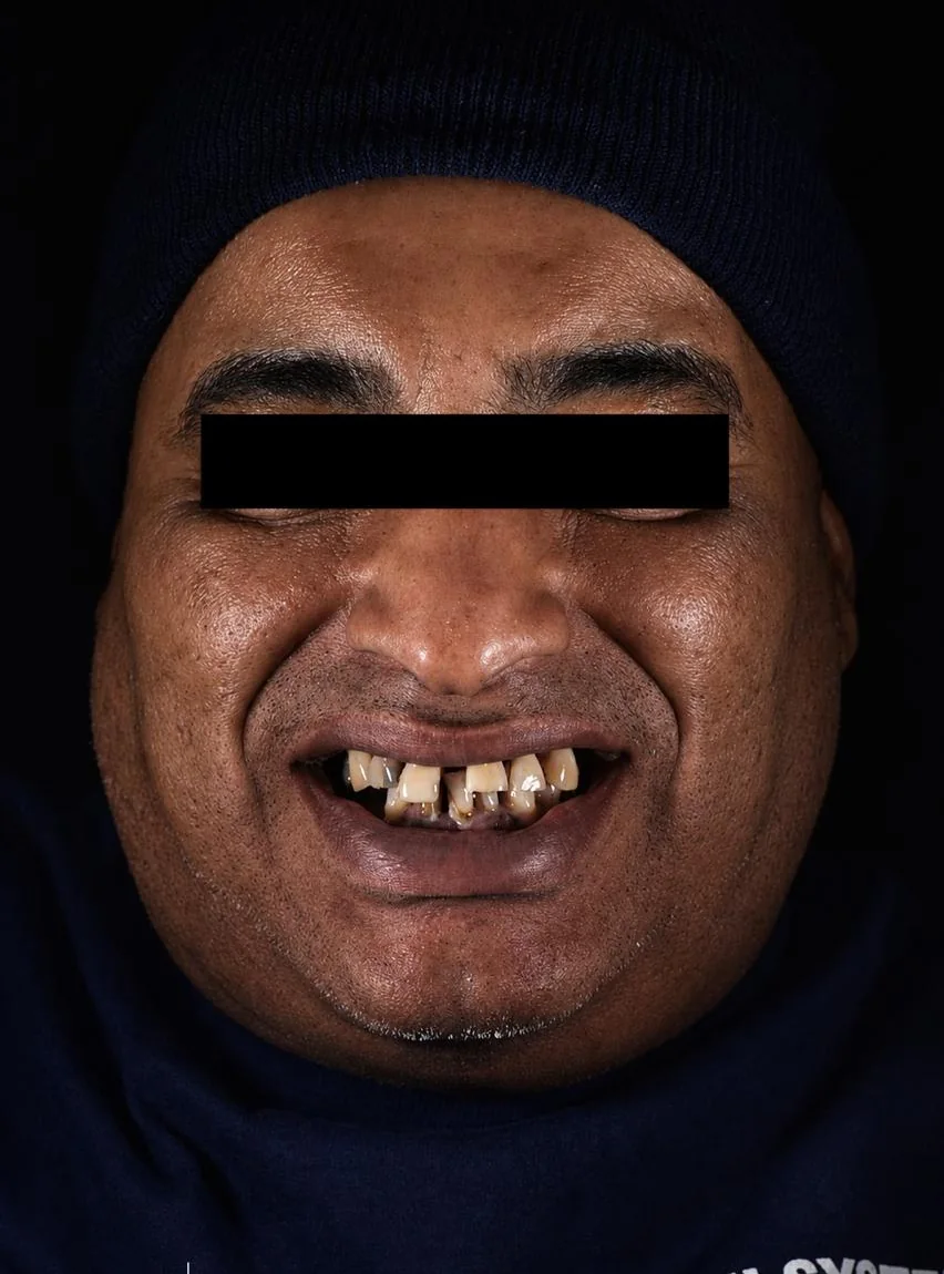 Patient 5 before treatment