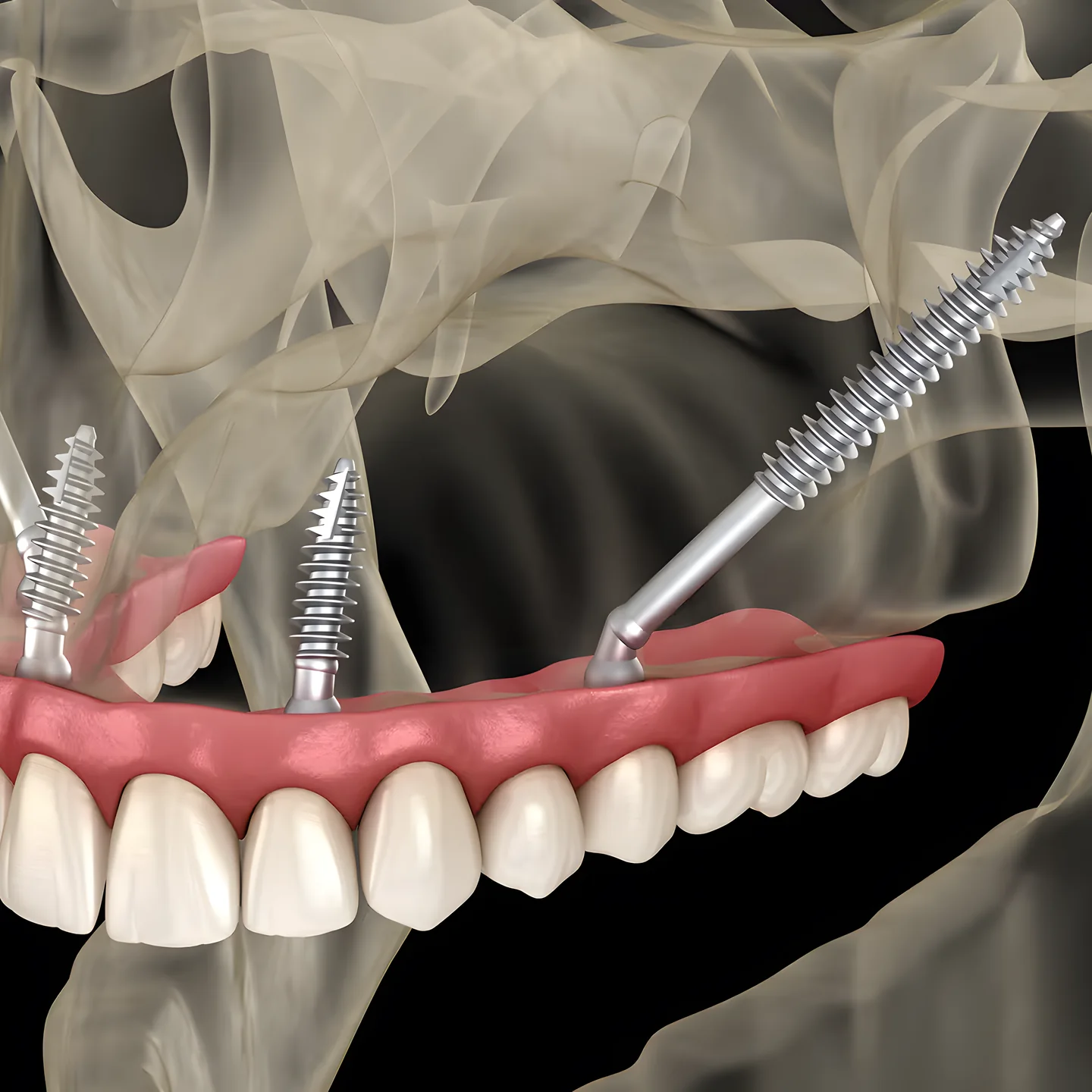 Zygomatic implants anchored in the cheekbone, holding a full upper arch (3D illustration)