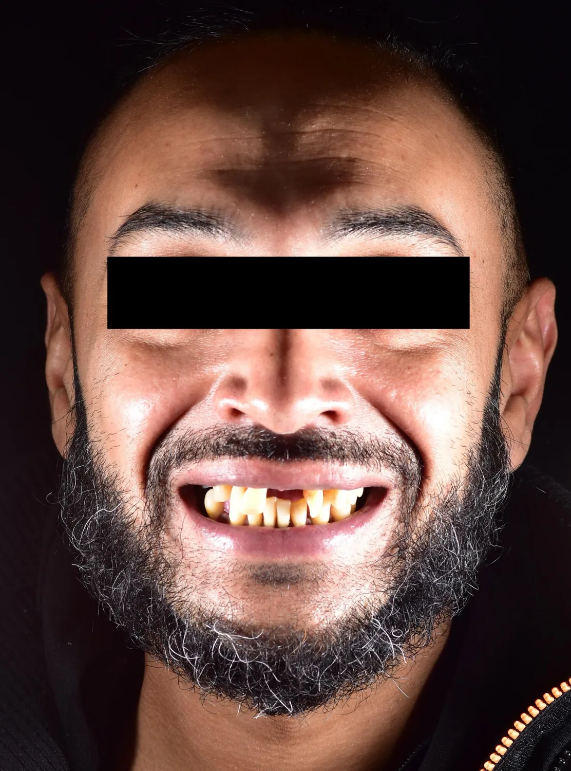 Patient one before dental implant treatment