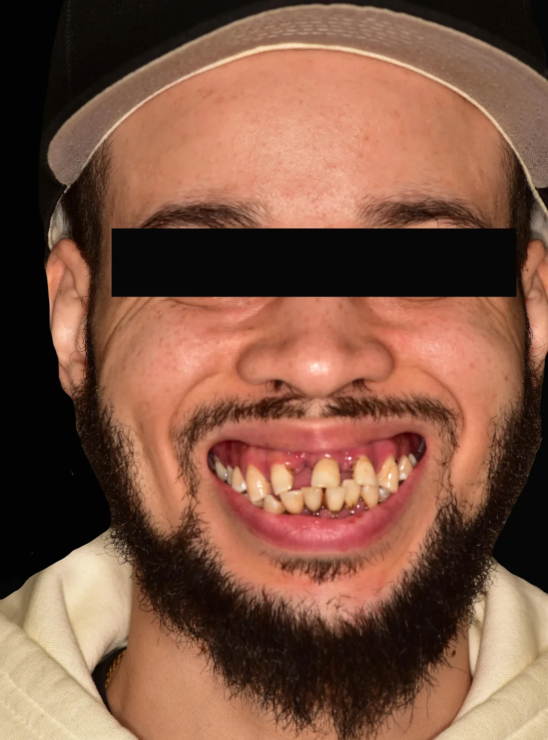Patient three before dental implant treatment